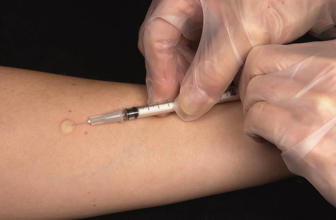I Mantoux tuberculin-testen injiseres en liten mengde av patogenens protein (tuberculin) i huden på innsiden av underarmen. Denne hudtesten brukes til å evaluere mennesker for latent tuberkuloseinfeksjon. Foto: CDC/Unsplash.